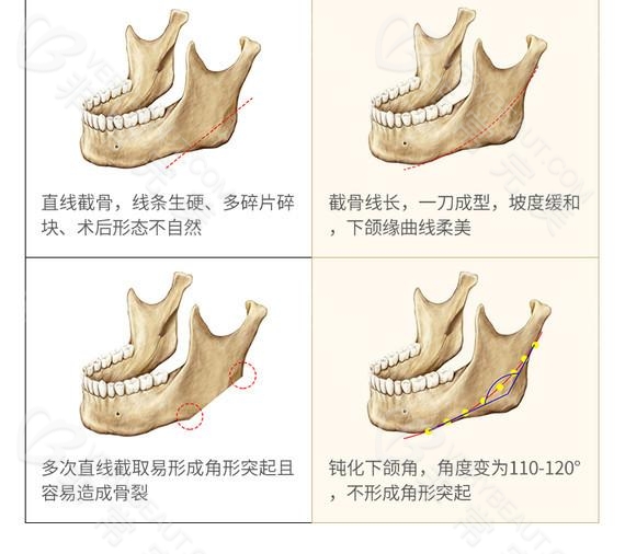 下颌角截骨方式