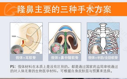 鼻综合隆鼻示意图