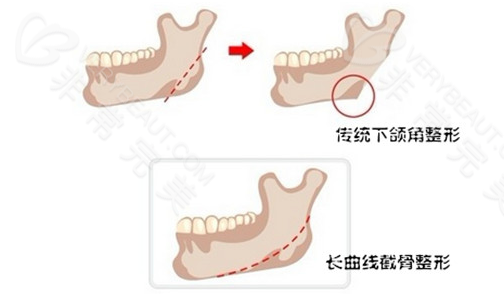 传统下颌角截骨和长曲线下颌角截骨图示