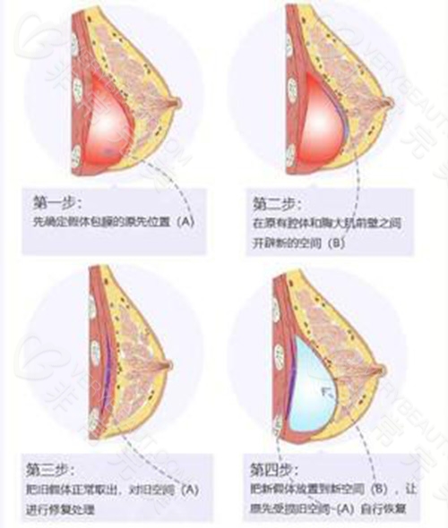 假体隆胸包膜挛缩表现图片