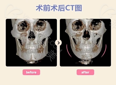颧骨手术CT图