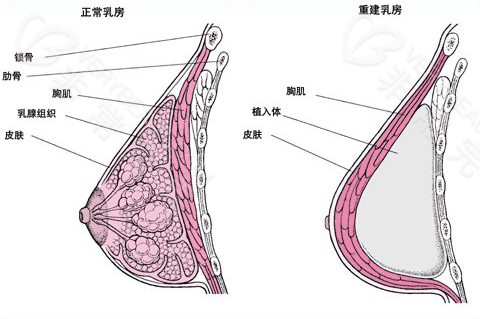 正常乳房和重建乳房对比