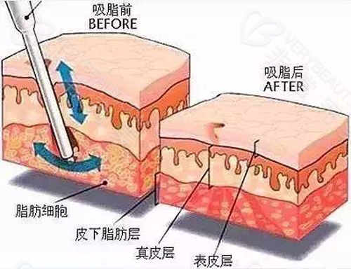 超声波吸脂图片