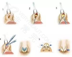 鼻综合手术流程