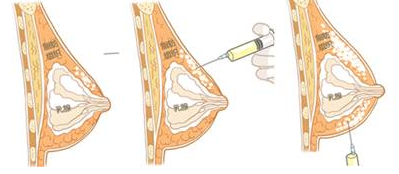 玻尿酸注射丰胸