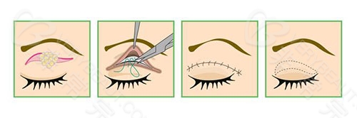 双眼皮手术示意图
