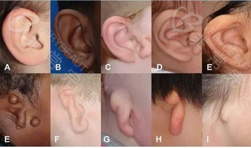 各种耳朵畸形示意图