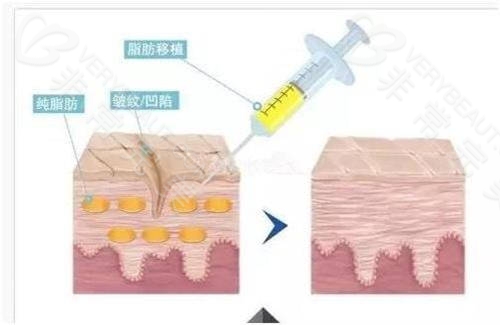 自体脂肪填充抚平细纹