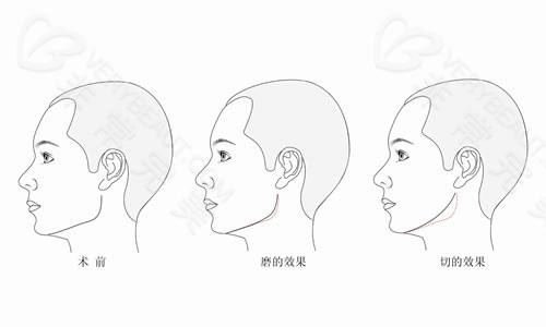 下颌角截骨与磨骨的区别