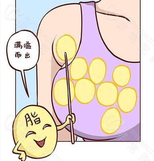 不正确的内衣穿着导致副乳