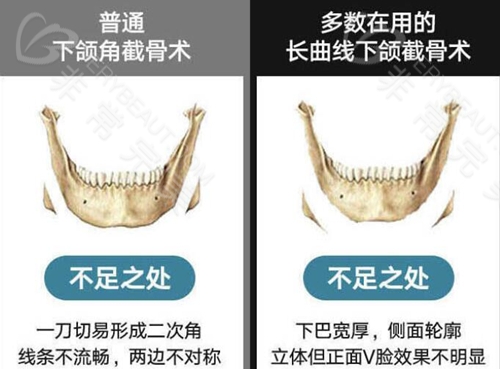 下颌骨长曲线截骨手术示意图