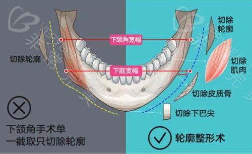 下颌骨长曲线截骨方法对比图