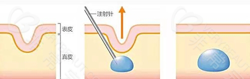 填充泪沟示意图