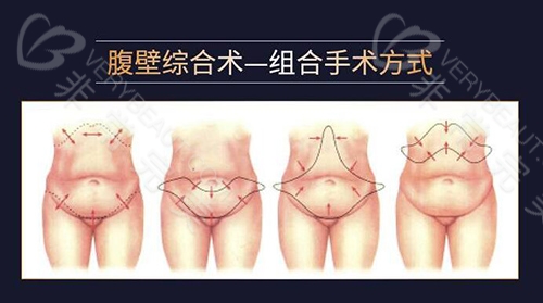 腹壁整形手术方法