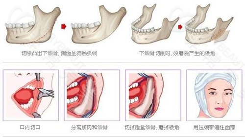 下颌角手术示意图