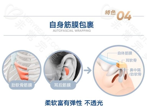 8C骨雕鼻自身筋膜包裹技术优势