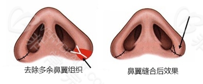 鼻翼缩小手术位置展示