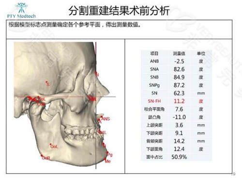 DPS轮廓整形手术术前分析测量图