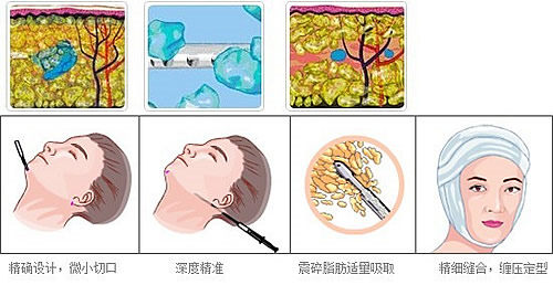 面部吸脂原理图片