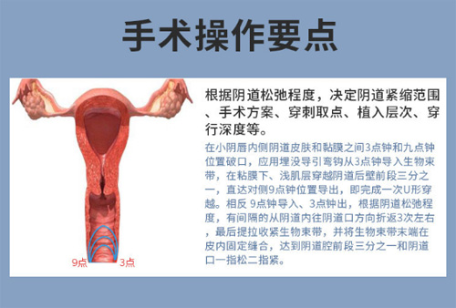 3d生物束带紧缩术原理