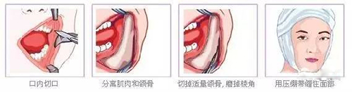 下颌角整形手术过程