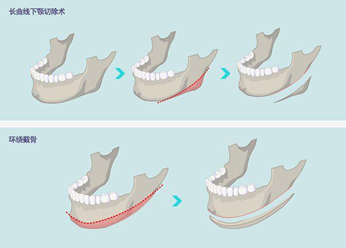 长曲线下颌角截骨术及环绕截骨过程