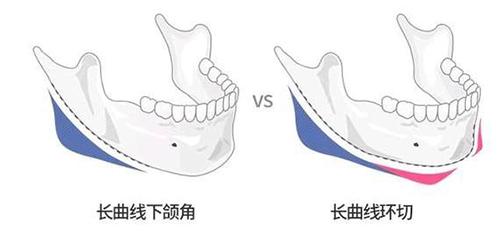 长曲线下颌角对比长曲线环切