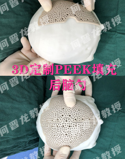 Peek材料填充后脑勺展示图