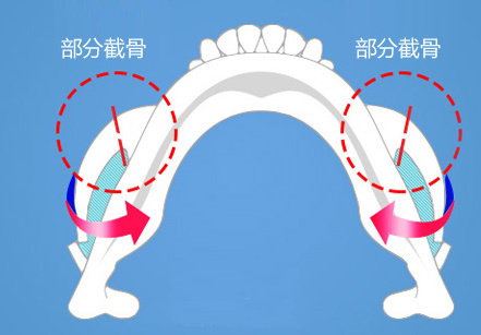 颧骨缩小手术示意图