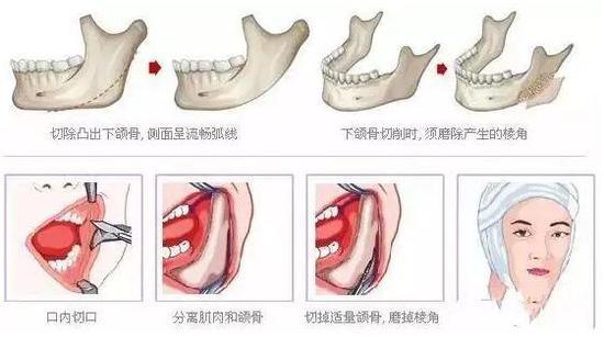 磨骨手术流程