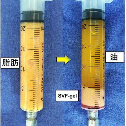 普通脂肪和脂肪胶对比