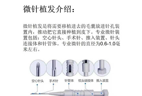 科普篇分析植髮種植筆跟微針技術區別種植頭髮哪種效果好