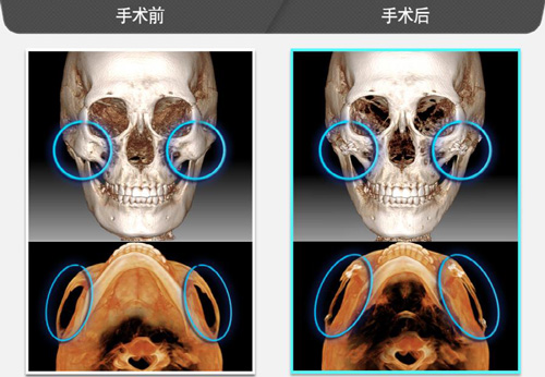 颧骨内推手术是怎么做的?行内人从颧骨手术方式发展来分析