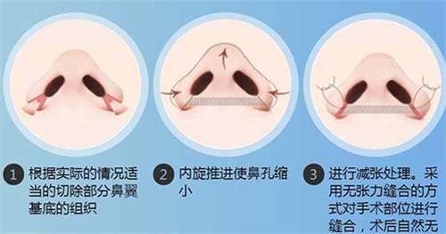 鼻翼缩小的手术方法