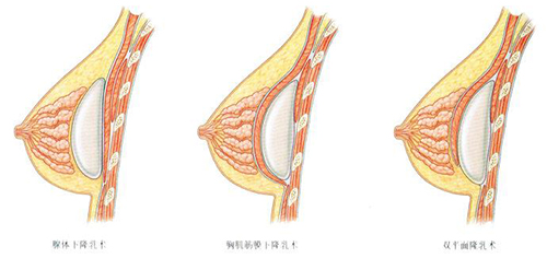 假体隆胸层次