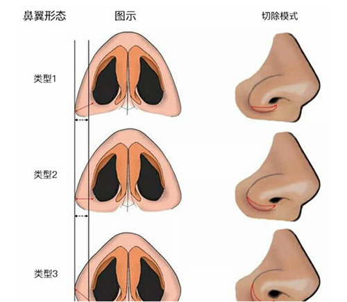 不同鼻翼类型的手术方式