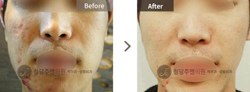 韩国清潭珠颜整形外科疤痕治疗前后