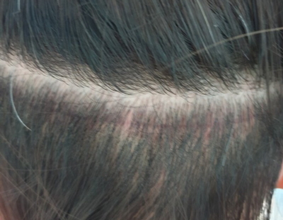 传统切开式植发后头皮内侧疤痕