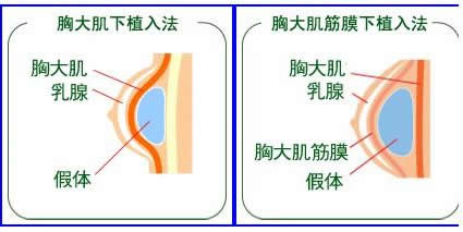 隆胸假体植入部位示意图