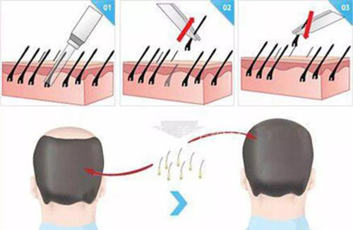 植发过程