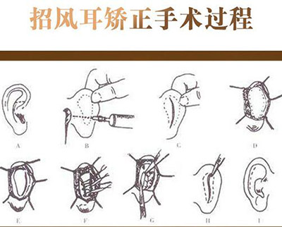 招风耳正畸改善过程