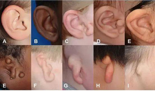 耳朵畸形形态示意图