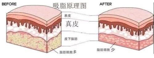 面部吸脂原理图片