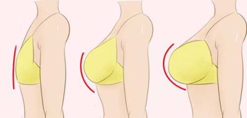 脂肪隆胸 后遗症图片