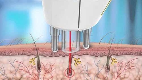 激光脱毛原理图片