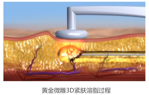 以面部吸脂为例,使用黄金微雕相当于溶脂 紧肤提升,相当于在做普通