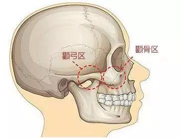 臉兩邊的顴骨寬怎麼辦不動手術顴骨外擴怎麼改善