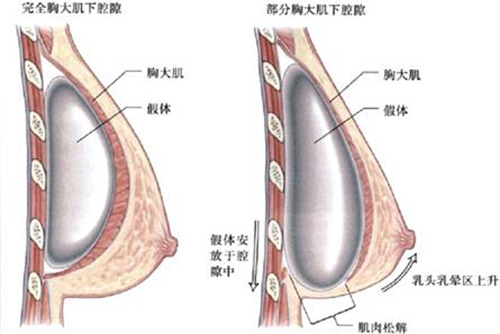 隆胸技术示意图