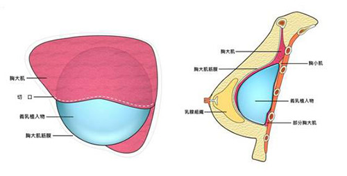 内窥镜隆胸技术