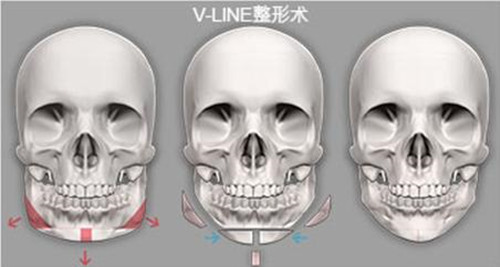 v-line手术位置
